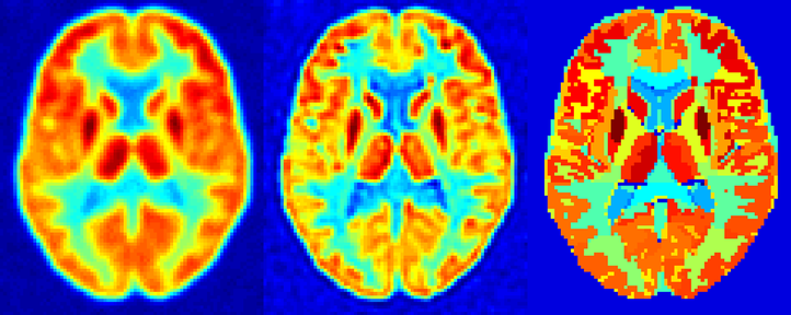 Figure 1: Phantom study for activity recovery in PET scans. Left: virtual PET scan; middle: PET-based correction (iterative deconvolution); right: MRI-based correction (Rousset)