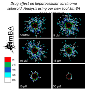 Drug effect on hepatocellular carcinoma spheroid